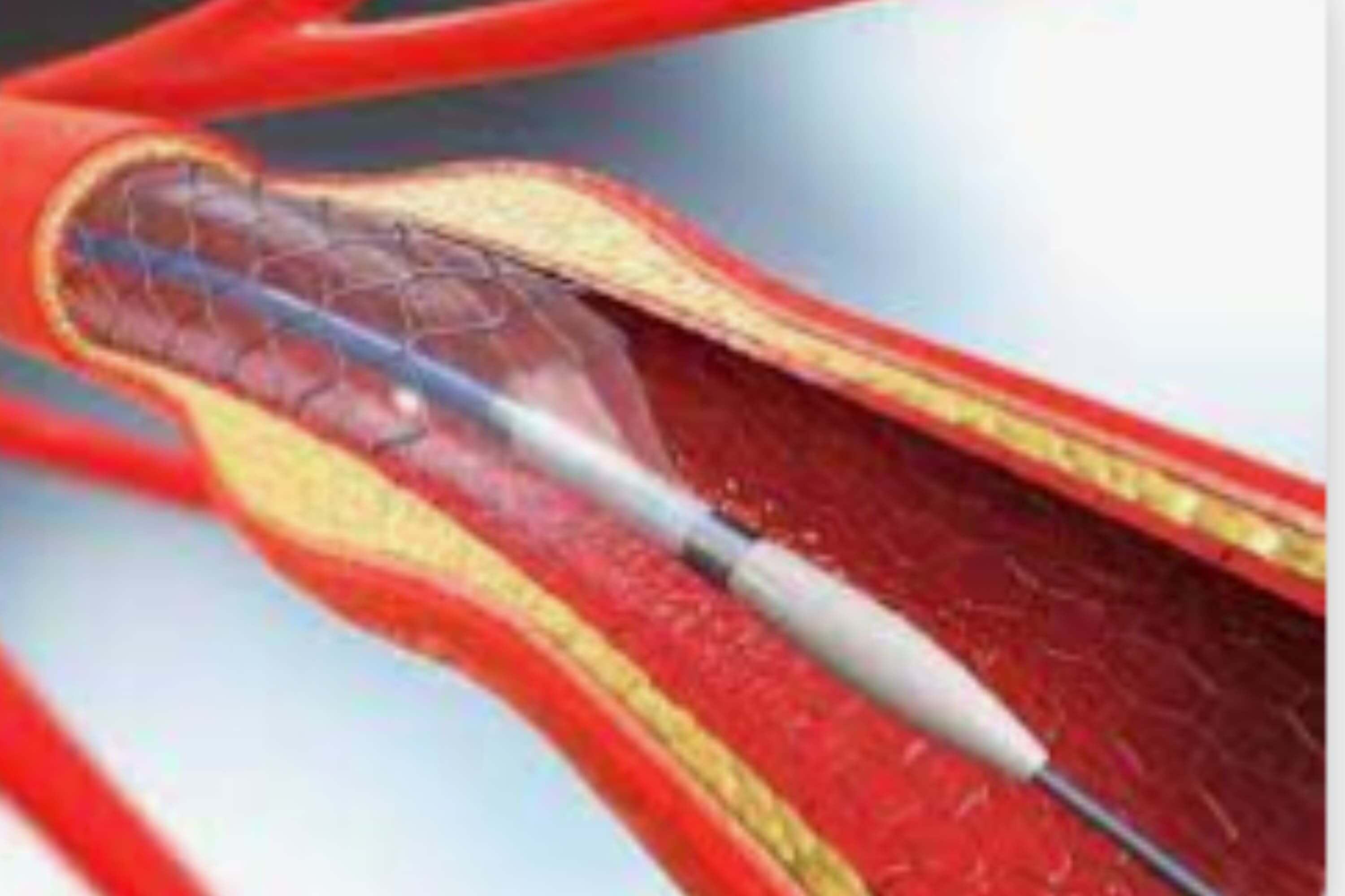 Cateterismo cardiaco diagnóstico y terapeútico